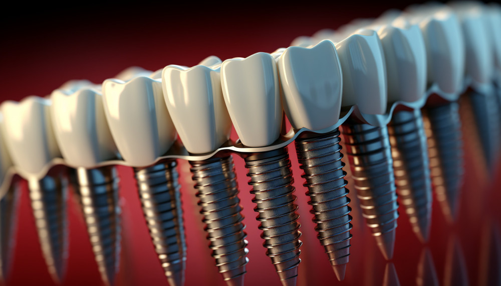 Quels sont les soins nécessaires après la pose d’implants dentaires ?